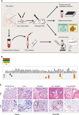 An Orthotopic Patient-Derived Xenograft (PDX) Model Allows the Analysis of Metastasis-Associated Features in Colorectal Cancer